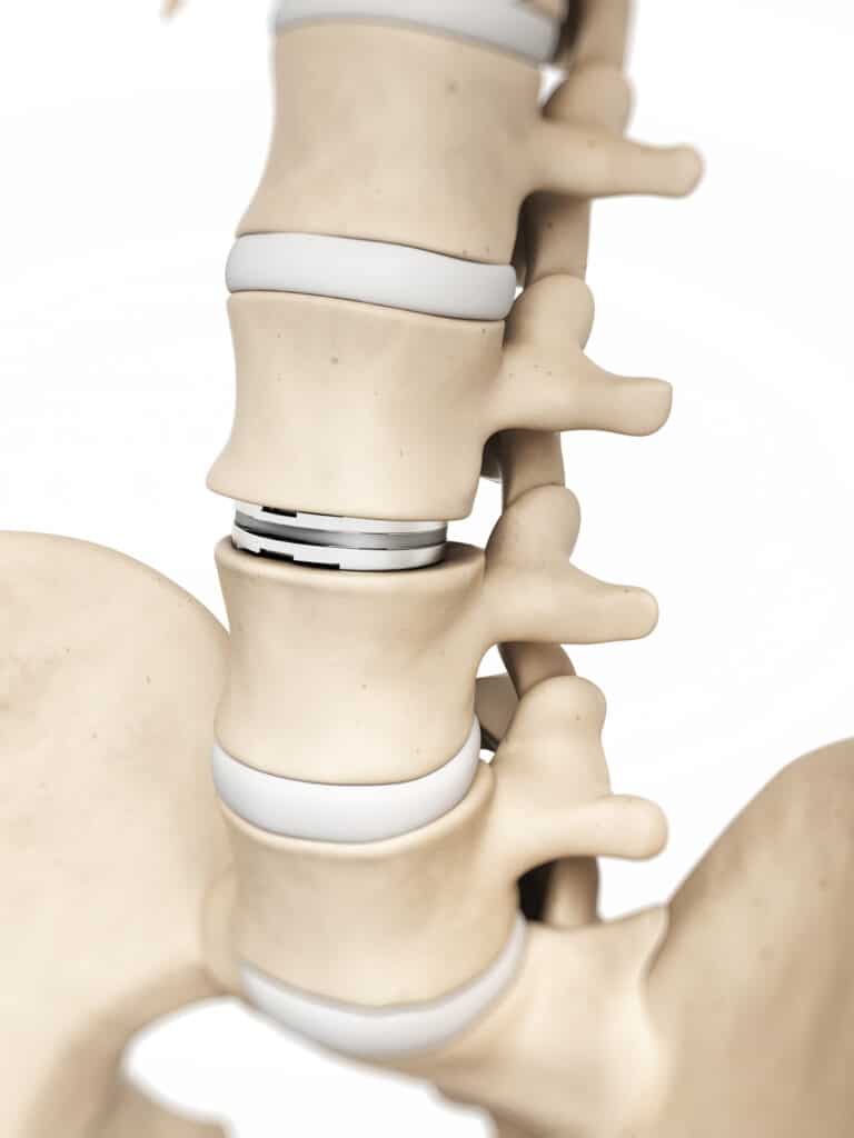 3D illustration of an artificial disc implant between two vertebrae