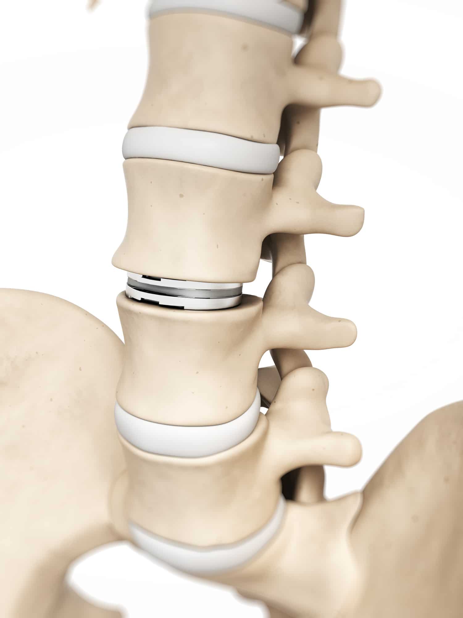 3d rendered illustration of an artificial disc