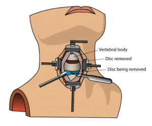 Illustration of an anterior cervical discectomy and fusion, with the disc removed and a spacer and plate in place