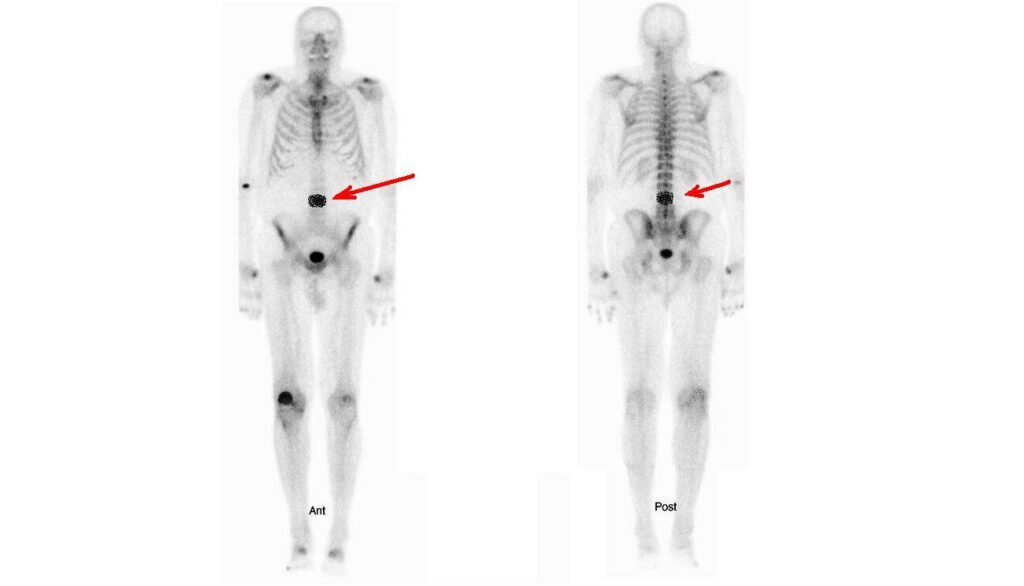 Whole-body bone scan with arrows pointing to cancer that has spread to a vertebra