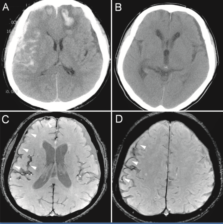 CT and MRI scans showing areas of bruising and bleeding in the brain after a head injury