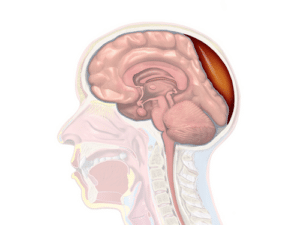 Illustration of a blood clot (hematoma) pressing on the brain beneath the skull