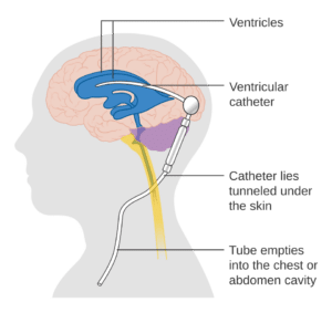 Diagram of a brain shunt, with a catheter in the ventricles of the brain and tubing running under the skin to the chest or abdomen