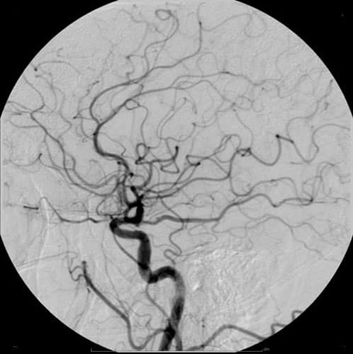 Cerebral angiogram showing the arteries of the brain