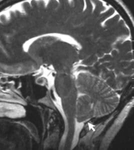 MRI of the brain with an arrow pointing to a Chiari malformation, where the lower cerebellum extends into the spinal canal