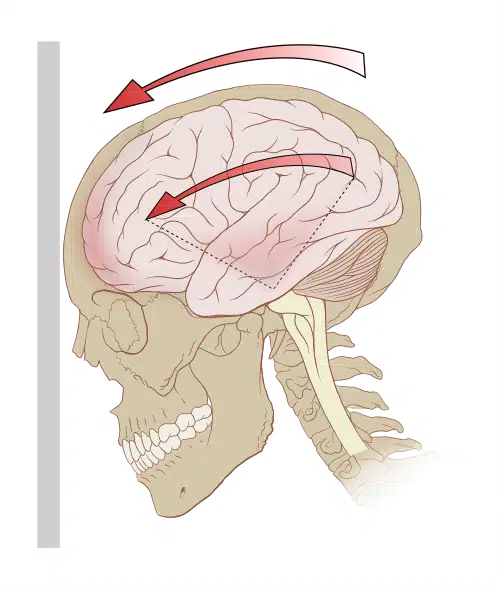Illustration showing how the brain moves inside the skull during a sudden jolt, causing a concussion