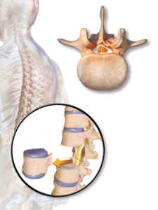 Illustration of a corpectomy, with a damaged vertebral body removed and replaced by a cage