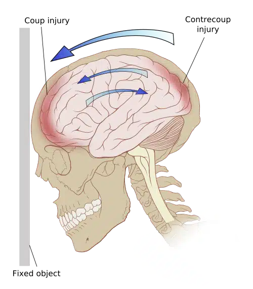 Illustration of coup and contrecoup injury, where the brain strikes both sides of the skull