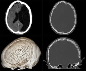 CT scans and a 3D reconstruction of a skull after cranioplasty, with a large skull opening covered by a custom implant