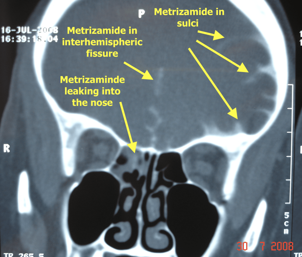 CT scan with contrast dye showing cerebrospinal fluid leaking into the nose