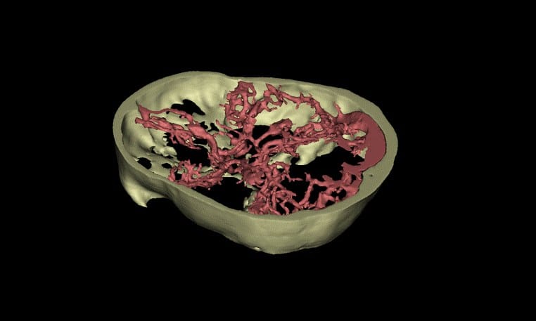 3D CT angiogram of the arteries at the base of the brain