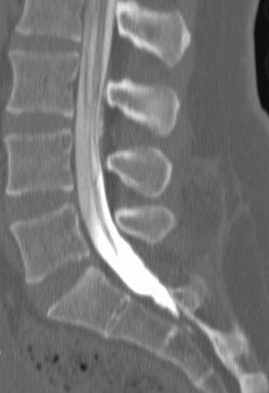 CT myelogram of the lumbar spine with contrast outlining the nerves