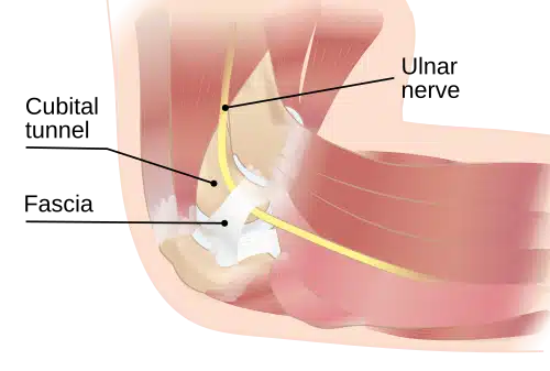 Illustration of the elbow showing the ulnar nerve compressed in the cubital tunnel
