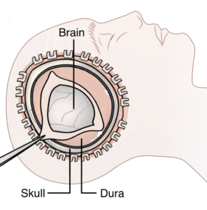 Illustration of a decompressive craniectomy, with part of the skull removed to let a swollen brain expand