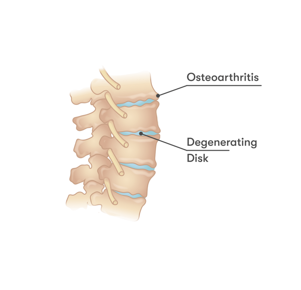 Close-up illustration of a worn, flattened spinal disc