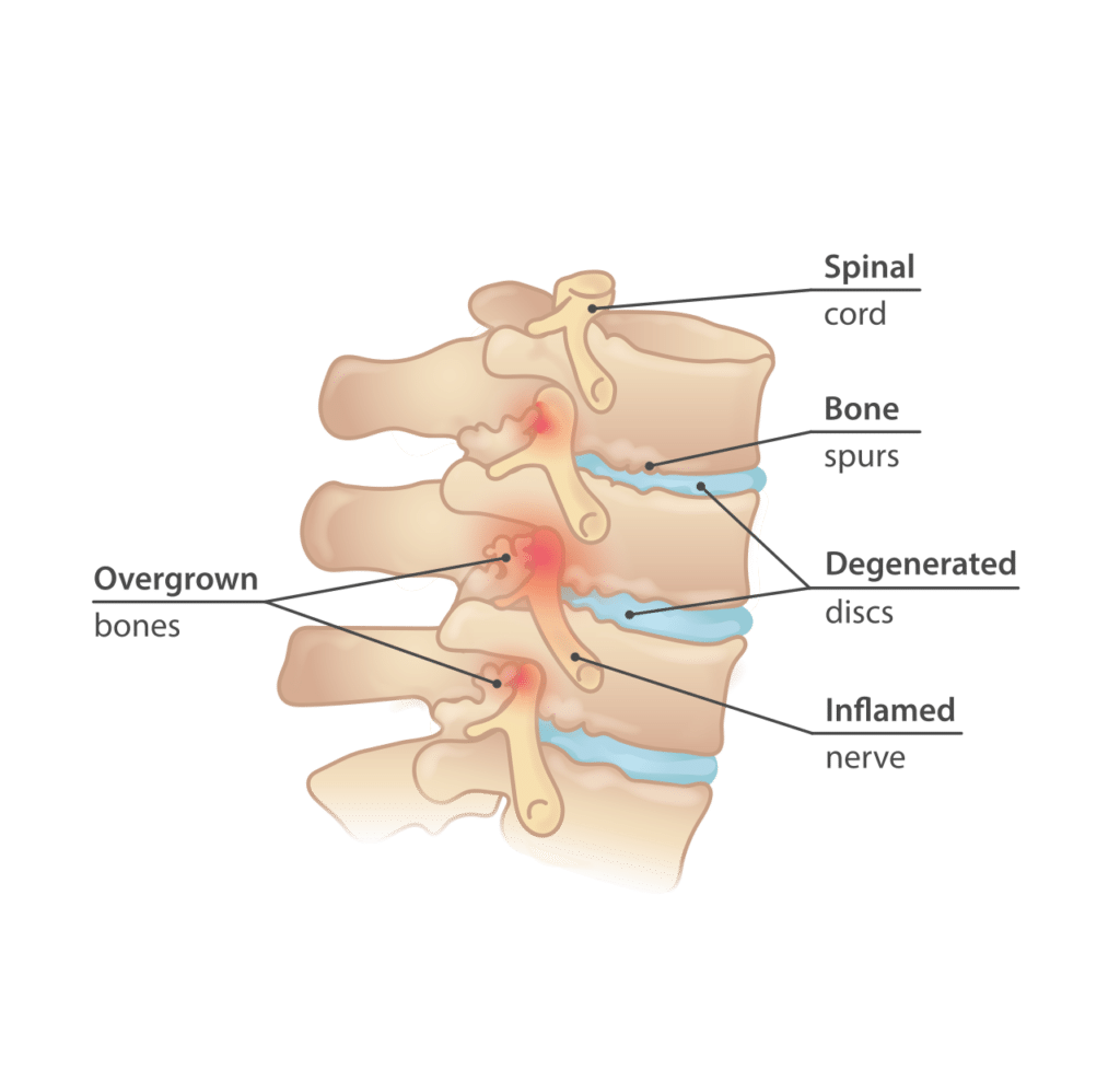 Illustration comparing a healthy disc with a degenerated disc