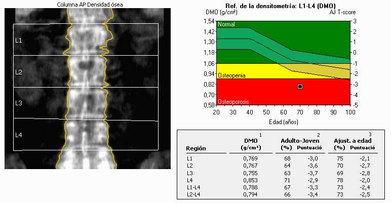 DEXA report of the lumbar spine showing osteoporosis