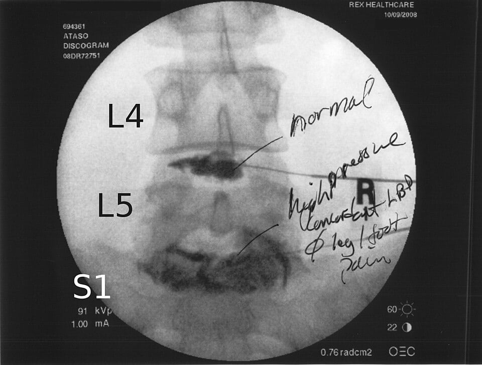 Discogram X-ray of the lower lumbar discs