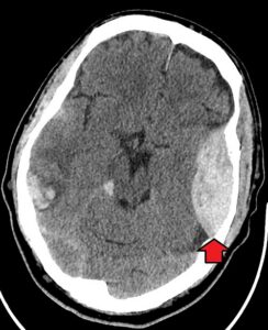 CT scan of the head with a red arrow pointing to an epidural hematoma