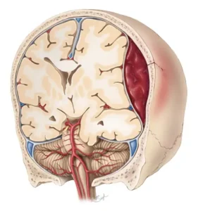 Illustration of an epidural hematoma, a blood clot between the skull and the covering of the brain, beneath a skull fracture