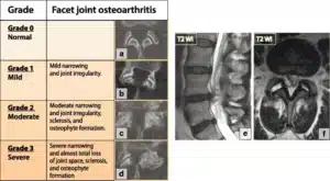 Illustration of degenerative changes in the facet joints of the spine