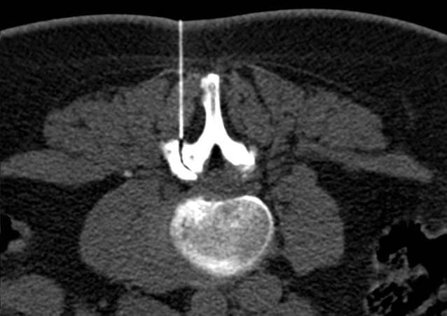 CT image of a needle placed in a lumbar facet joint for an injection