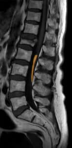 MRI of the lower spine with a fatty filum terminale highlighted, a common cause of tethered cord