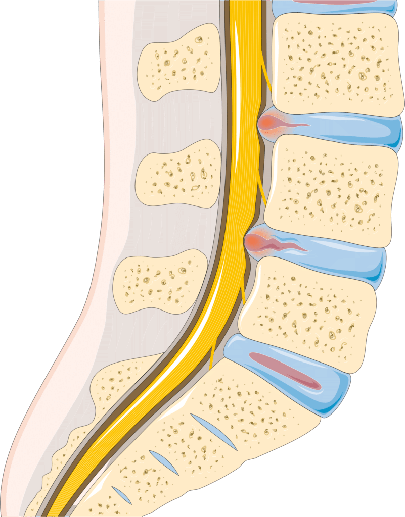 Illustration of a herniated lumbar disc pressing on a spinal nerve