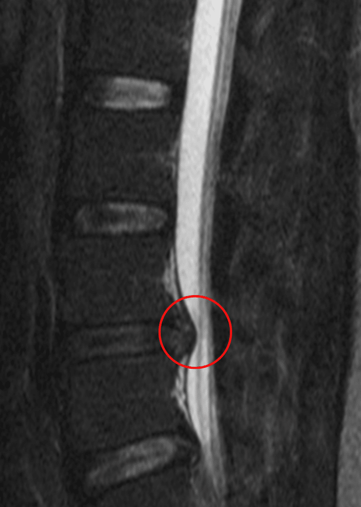 MRI of the lower spine showing a disc herniation pressing on a nerve