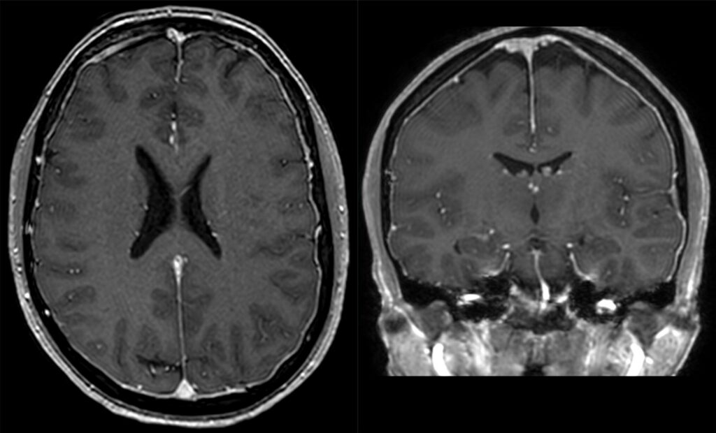 Contrast MRI showing thickened, bright brain lining (meningeal enhancement), a common sign of low CSF pressure