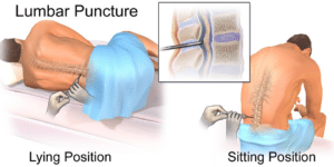Illustration of the spinal fluid space in the lower back, where an intrathecal catheter delivers medicine