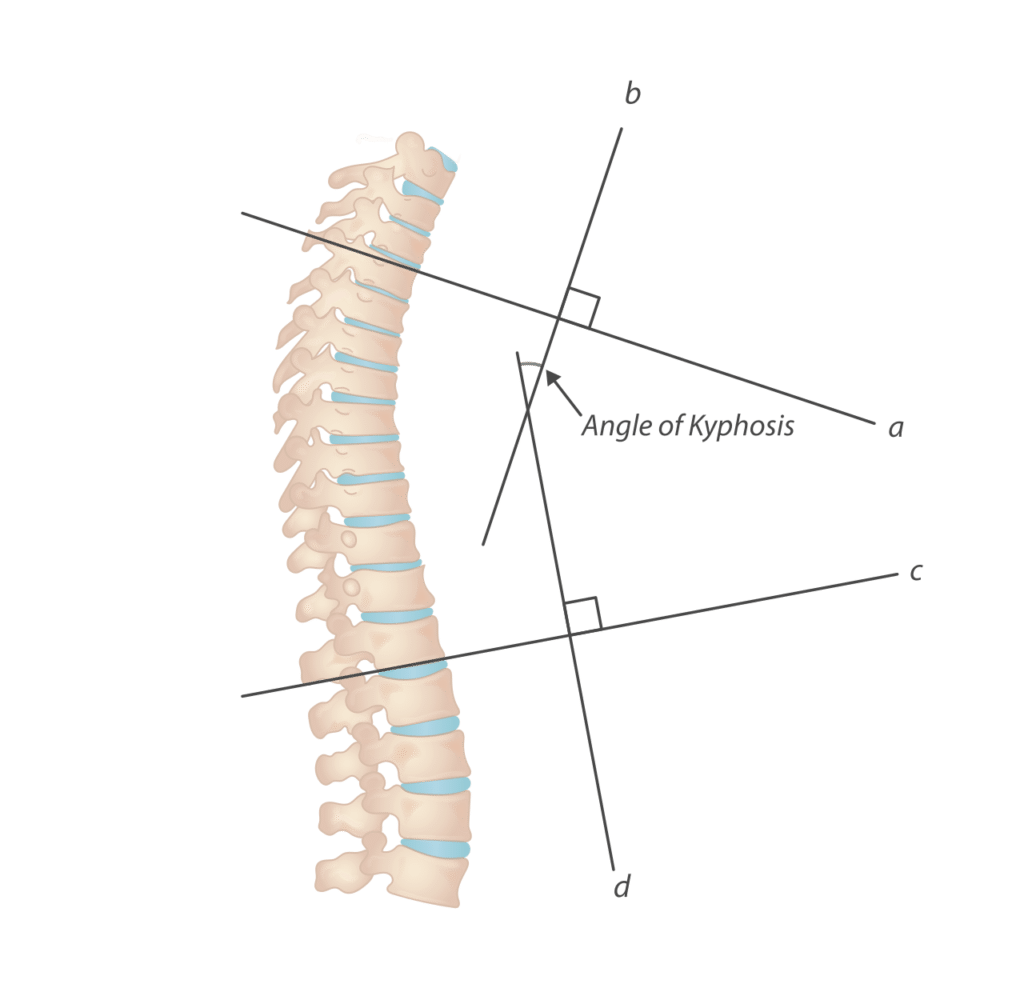Illustration showing how the angle of kyphosis is measured