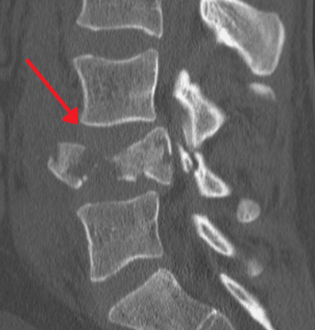 CT scan showing a burst fracture of a lumbar vertebra