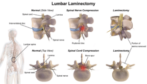 Illustration of a lumbar laminectomy removing the back of the vertebra to relieve pressure on the nerves