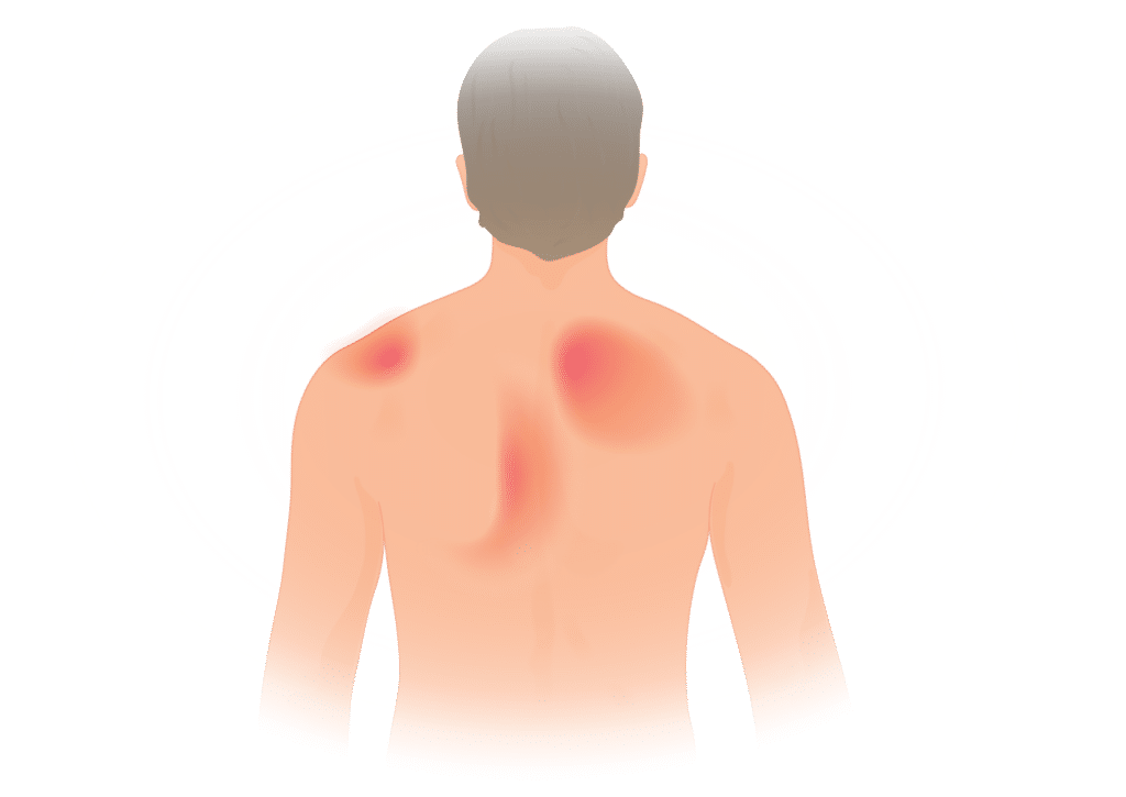 Illustration of a man with low back pain
