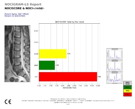 Sample Nociscan report showing a lumbar MRI next to a bar chart that scores each disc level