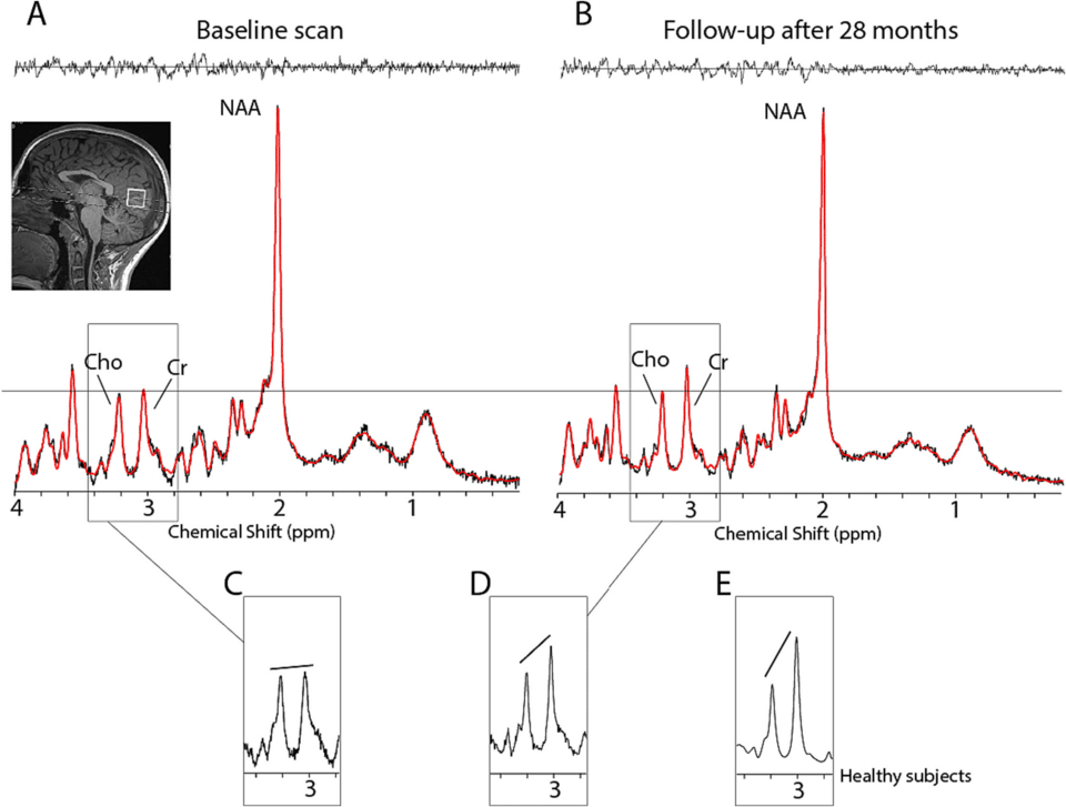 MR spectroscopy graph showing peaks for brain chemicals