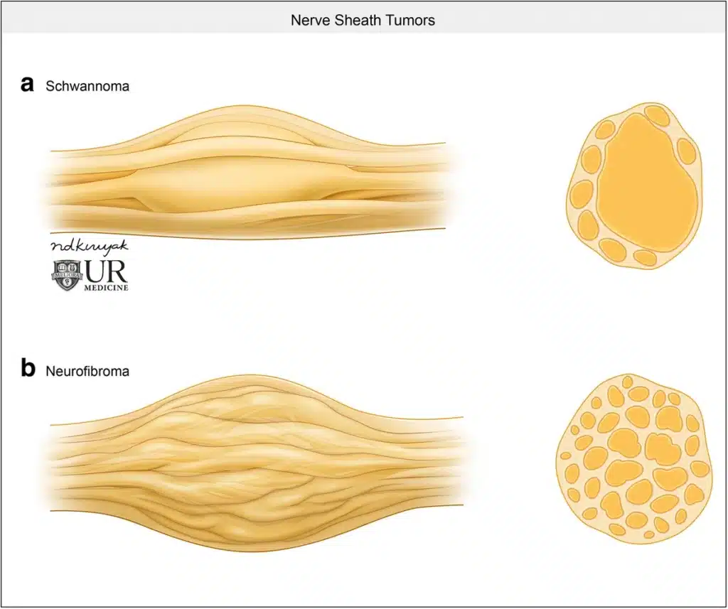 Illustration comparing a schwannoma, which grows off to one side of a nerve, with a neurofibroma, which grows within the nerve