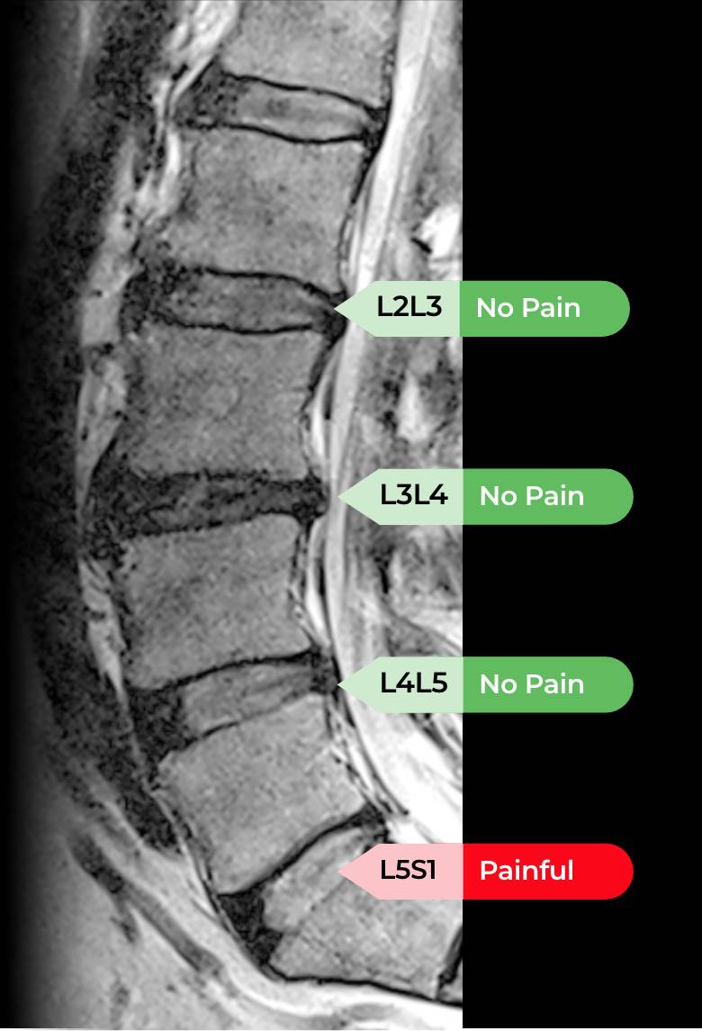 Nociscan and chronic low back pain