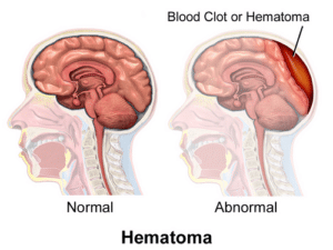 Illustration comparing a normal brain with a brain compressed by a blood clot between the skull and brain