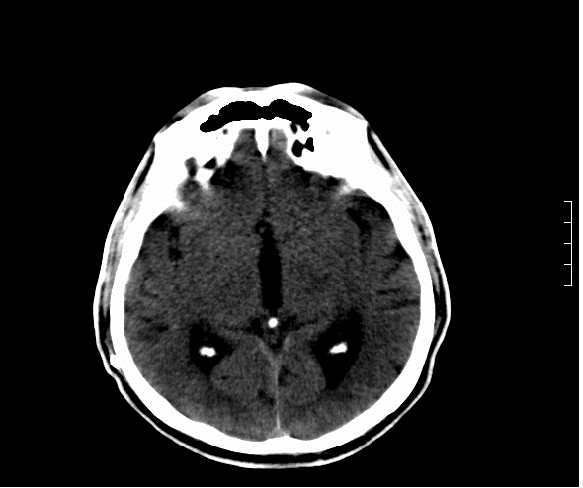 CT scan showing enlarged ventricles in normal pressure hydrocephalus