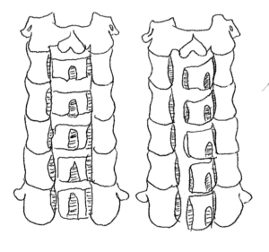 Illustration of an open-door cervical laminoplasty widening the spinal canal