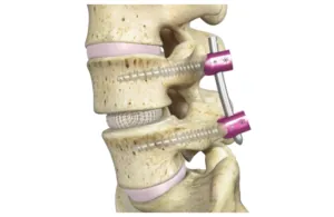 Illustration of an OptiLIF lumbar fusion with an interbody implant and percutaneous screws and rod