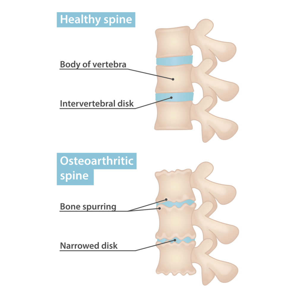 Illustration of arthritis in the spine