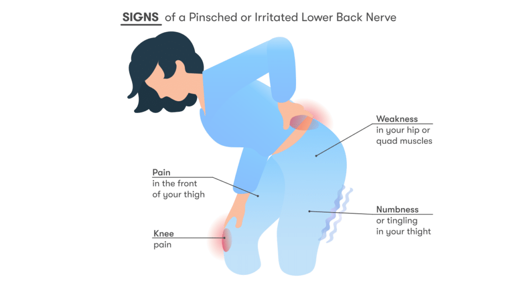 Illustration of the signs of a pinched nerve