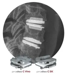 X-ray of the neck showing artificial discs at two levels, with the prodisc C Vivo and prodisc C SK implants
