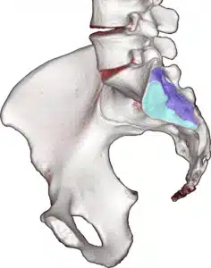 Illustration of the sacroiliac joint between the sacrum and the pelvic bone