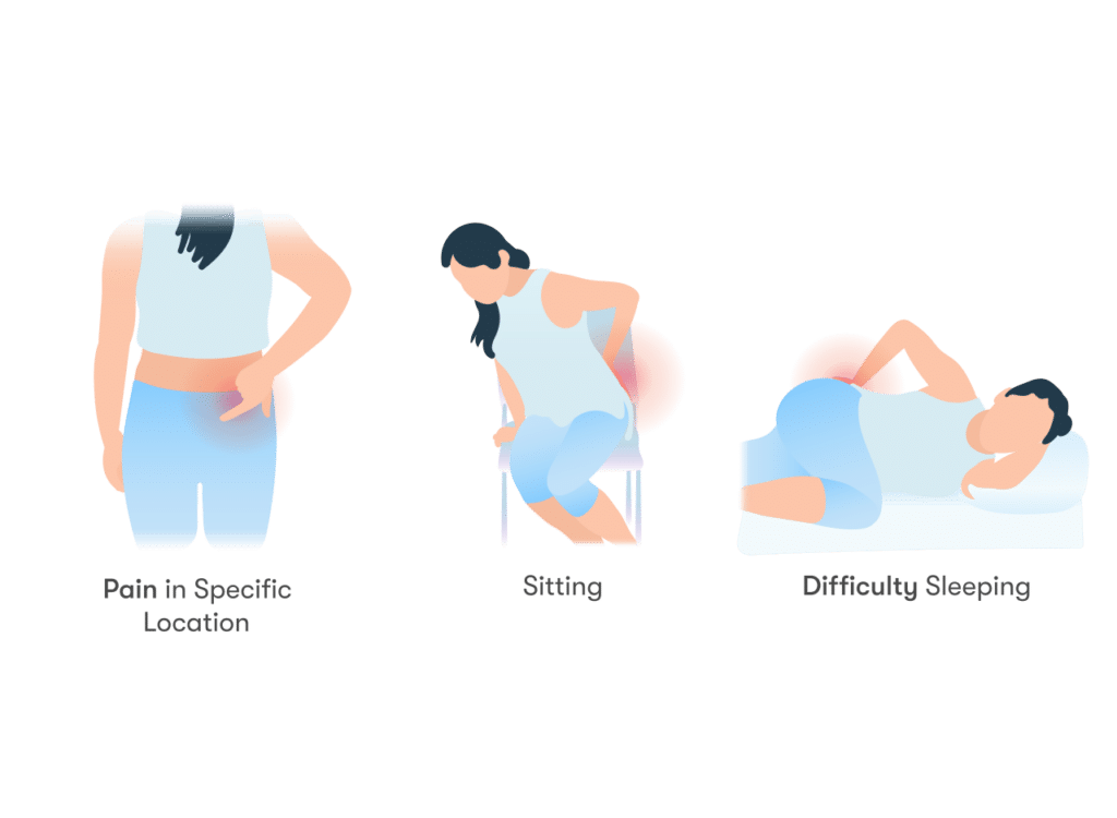 Illustration of where sacroiliac joint pain is usually felt