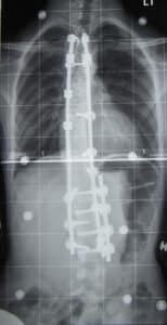 X-ray of the spine after scoliosis correction with rods and screws
