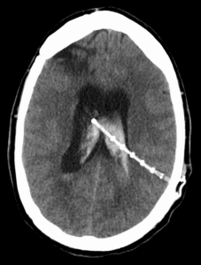 CT scan of the head showing a shunt catheter in the fluid spaces of the brain
